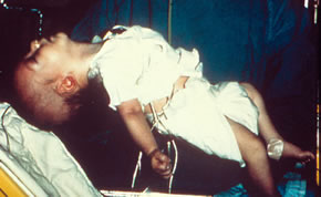 [Infant Flaccid Paralysis. Courtesy of The CDC]